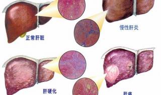 治疗肝炎需要多少钱 治疗肝炎需要多少钱